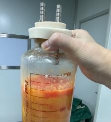 当阳水动力吸脂手术要做多久？